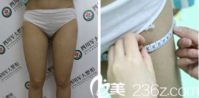 大腿吸脂前腿部情況 大腿吸脂前腿部情況