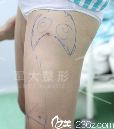 腿部吸脂術(shù)前設(shè)計 腿部吸脂術(shù)前設(shè)計