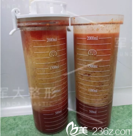 大腿被抽取出的脂肪 大腿被抽取出的脂肪