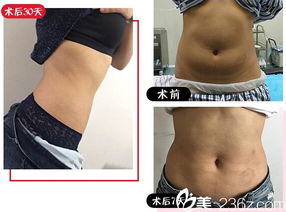 東莞南城西妃整形醫(yī)院戴新明做的腰腹部吸脂案例