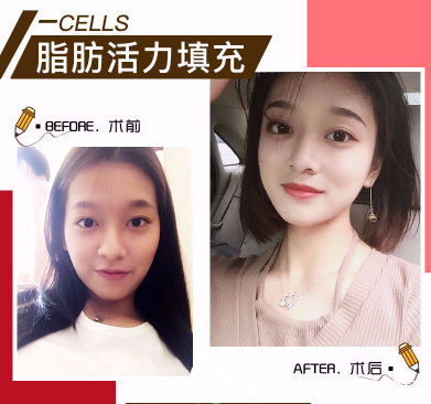 東莞南城西妃戴新明做的自體脂肪填充案例