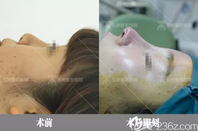 術(shù)后即刻對比效果