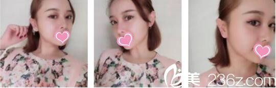 閨蜜在韓國(guó)DrBe做了韓式雙眼皮效果特別自然，于是我找金泰中做了面部埋線提升