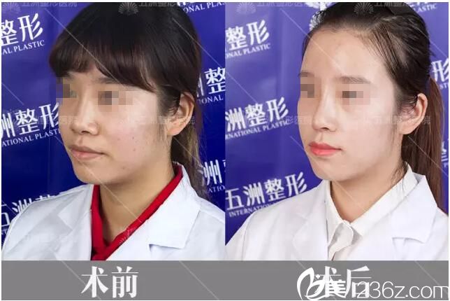 術(shù)后15天側(cè)面對比效果
