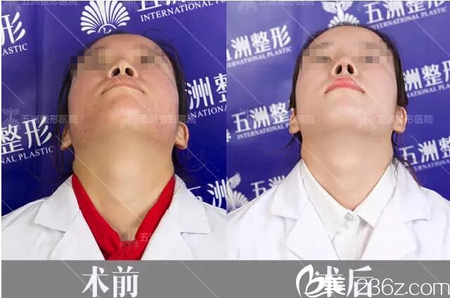 術(shù)后15天仰面對比效果