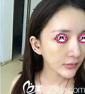 北京葉子楊峰給我做埋線提升第4天樣子