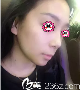 在北京葉子做意大利悅生線埋線提升第13天效果