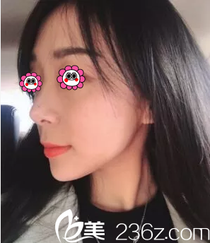 北京葉子埋線提升案例