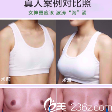 劉明飛醫(yī)生假體豐胸真人效果圖分享 劉明飛醫(yī)生假體豐胸真人效果圖分享