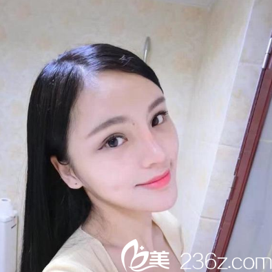 深圳鵬程<!--<i data=20240703-sp></i>-->醫(yī)生隆鼻案例一個(gè)月圖片