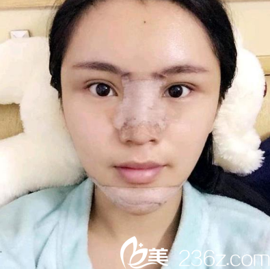 深圳鵬程<!--<i data=20240703-sp></i>-->隆鼻案例術(shù)后5天圖片