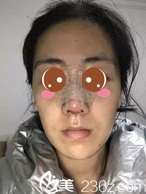 自體耳軟骨+硅膠隆鼻后1天