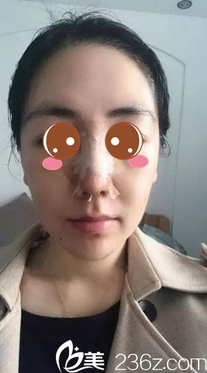 西寧時(shí)光整形醫(yī)院鼻綜合手術(shù)<span style=