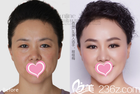 沈陽杏林激光祛斑美膚真人對比照