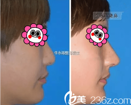 北京美萊<!--<i data=20240703-sp></i>-->假體隆鼻案例