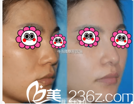 北京美萊<!--<i data=20240703-sp></i>-->鼻綜合案例