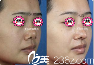 北京美萊<!--<i data=20240703-sp></i>-->鼻修復(fù)案例