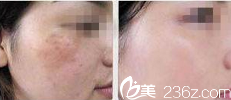 遼寧沈陽激光祛斑真人對比照
