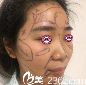 亞韓醫(yī)生給我進行V塑加面部脂肪填充設(shè)計照 亞韓醫(yī)生給我進行V塑加面部脂肪填充設(shè)計照