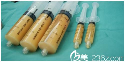 自體脂肪的存活率與哪些因素有關(guān)