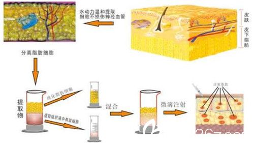 自體脂肪填充全臉
