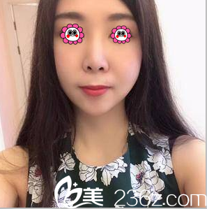 在北京亞韓做V塑減面部吸脂第26天效果 在北京亞韓做V塑減面部吸脂第26天效果