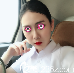 公開我在北京亞韓做V塑減面部吸脂第95天效果和價格