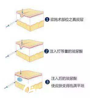 玻尿酸填充鼻唇溝
