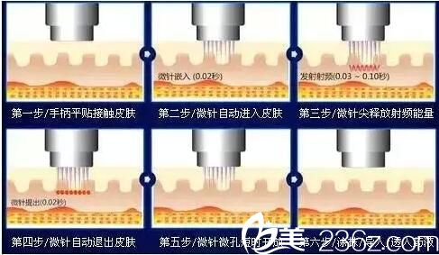 黃金點(diǎn)陣射頻和熱瑪吉的區(qū)別