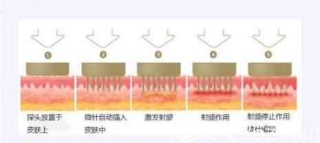 黃金點(diǎn)陣射頻