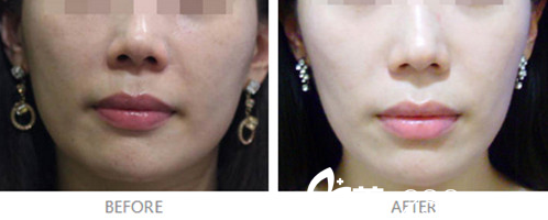 埋線提升對比圖 埋線提升對比圖