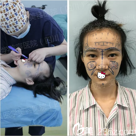 肋軟骨隆鼻+脂肪面部填充術前設計 肋軟骨隆鼻+脂肪面部填充術前設計