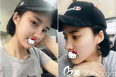 黃小林鼻綜合拆線后效果 黃小林鼻綜合拆線后效果