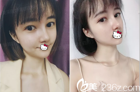  ?成都美萊黃小林跟雷狀我選黃小林做肋軟骨隆鼻手術(shù)的原因 