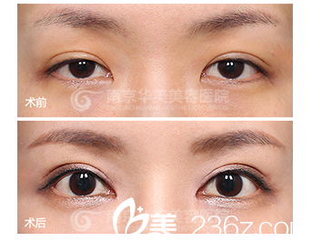 南京華美雙眼皮過寬修復(fù)案例