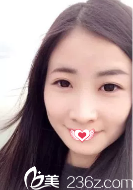 術(shù)前鼻子塌平寬大 術(shù)前鼻子塌平寬大