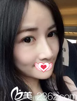 術(shù)后2個月鼻子恢復(fù)自然 術(shù)后2個月鼻子恢復(fù)自然