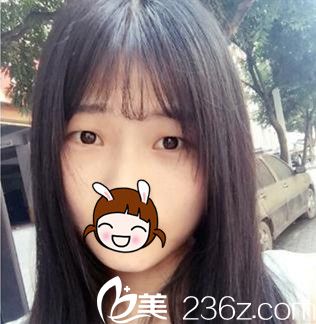 術(shù)前單眼皮 術(shù)前單眼皮