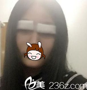 剛做完7mm平行雙眼皮 剛做完7mm平行雙眼皮