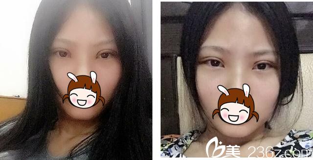 雙眼皮術(shù)后6天恢復(fù) 雙眼皮術(shù)后6天恢復(fù)