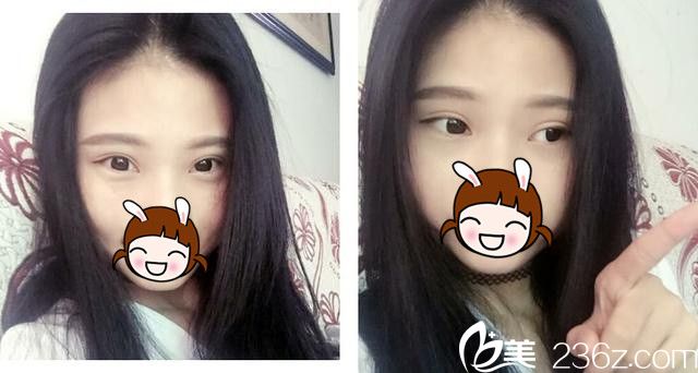 術(shù)后半個(gè)月雙眼皮恢復(fù)中 術(shù)后半個(gè)月雙眼皮恢復(fù)中