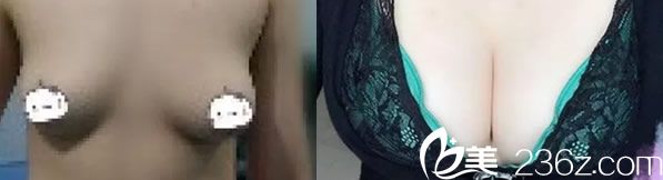 在韓國藝雅特整形崔平林院長的自體脂肪隆胸術后趴著有溝，站著成杯