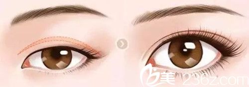 雙眼皮手術(shù)修復(fù)