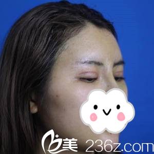 雙眼皮拆線后的效果 雙眼皮拆線后的效果