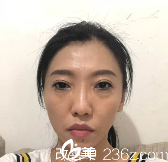 感覺眼睛沒有皮膚恢復(fù)的好