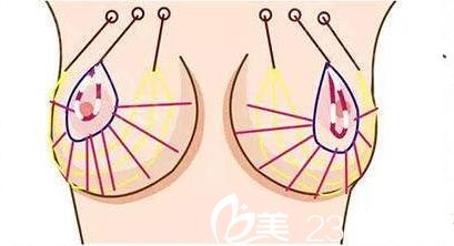 自體脂肪隆胸效果好不好？
