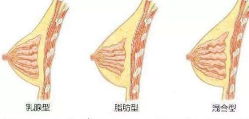 自體脂肪隆胸需要做幾次？