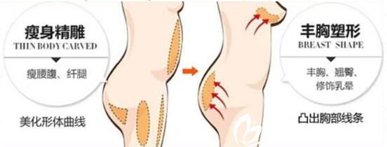 自體脂肪隆胸能被吸收多少？