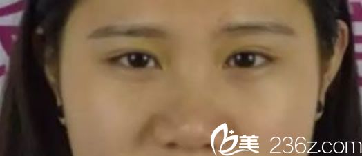 韓國娜娜整形外科醫(yī)院鼻部整形前 韓國娜娜整形外科醫(yī)院鼻部整形前