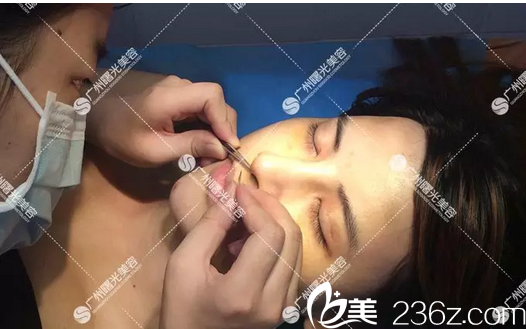 廣州曙光隆鼻術(shù)后14天拆內(nèi)線 廣州曙光隆鼻術(shù)后14天拆內(nèi)線